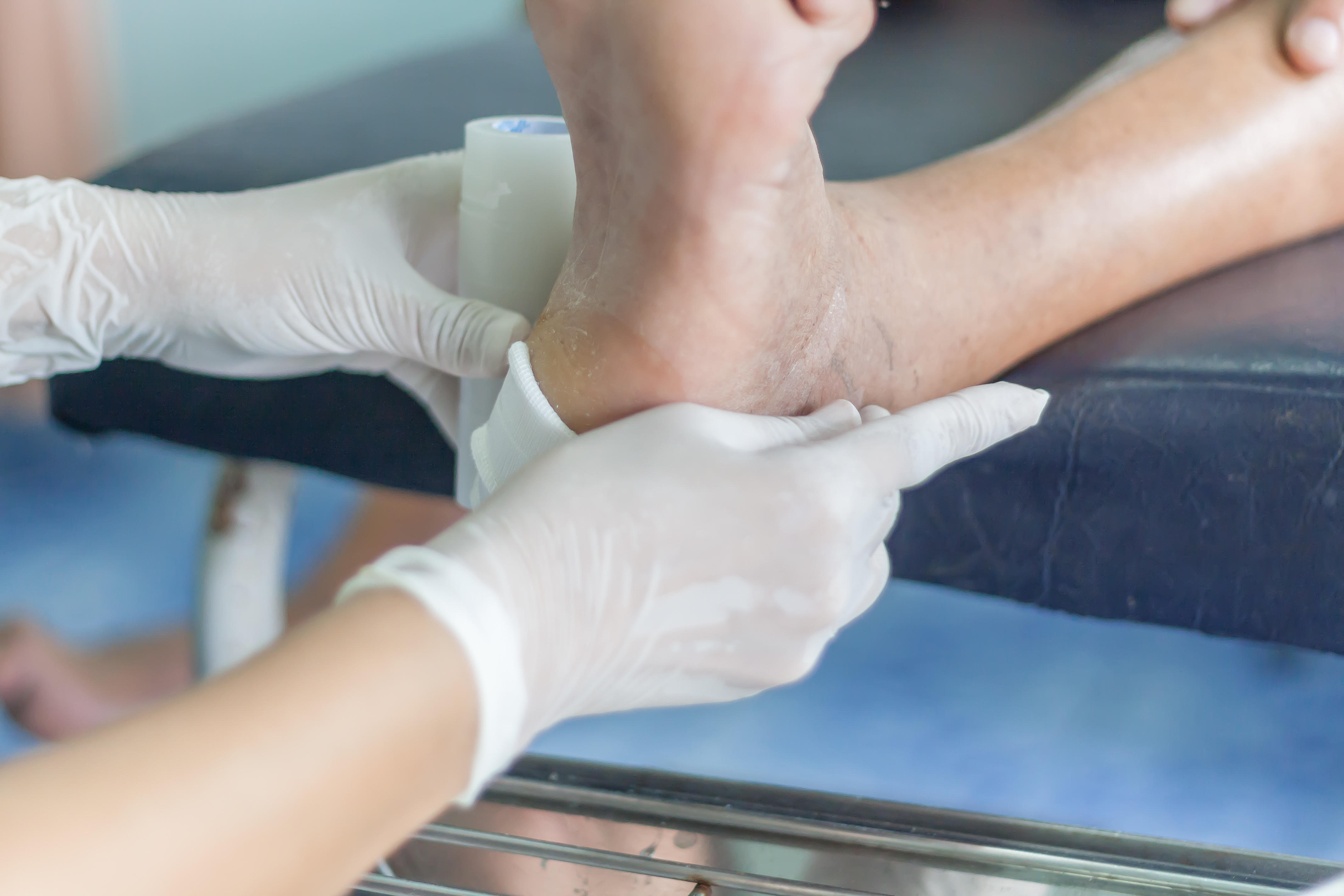 Une procédure chirurgicale proactive, simple et peu coûteuse pour les ulcères du pied diabétique permet de réduire, considérablement, le délai de cicatrisation  (Visuel Adobe Stock 165767373)