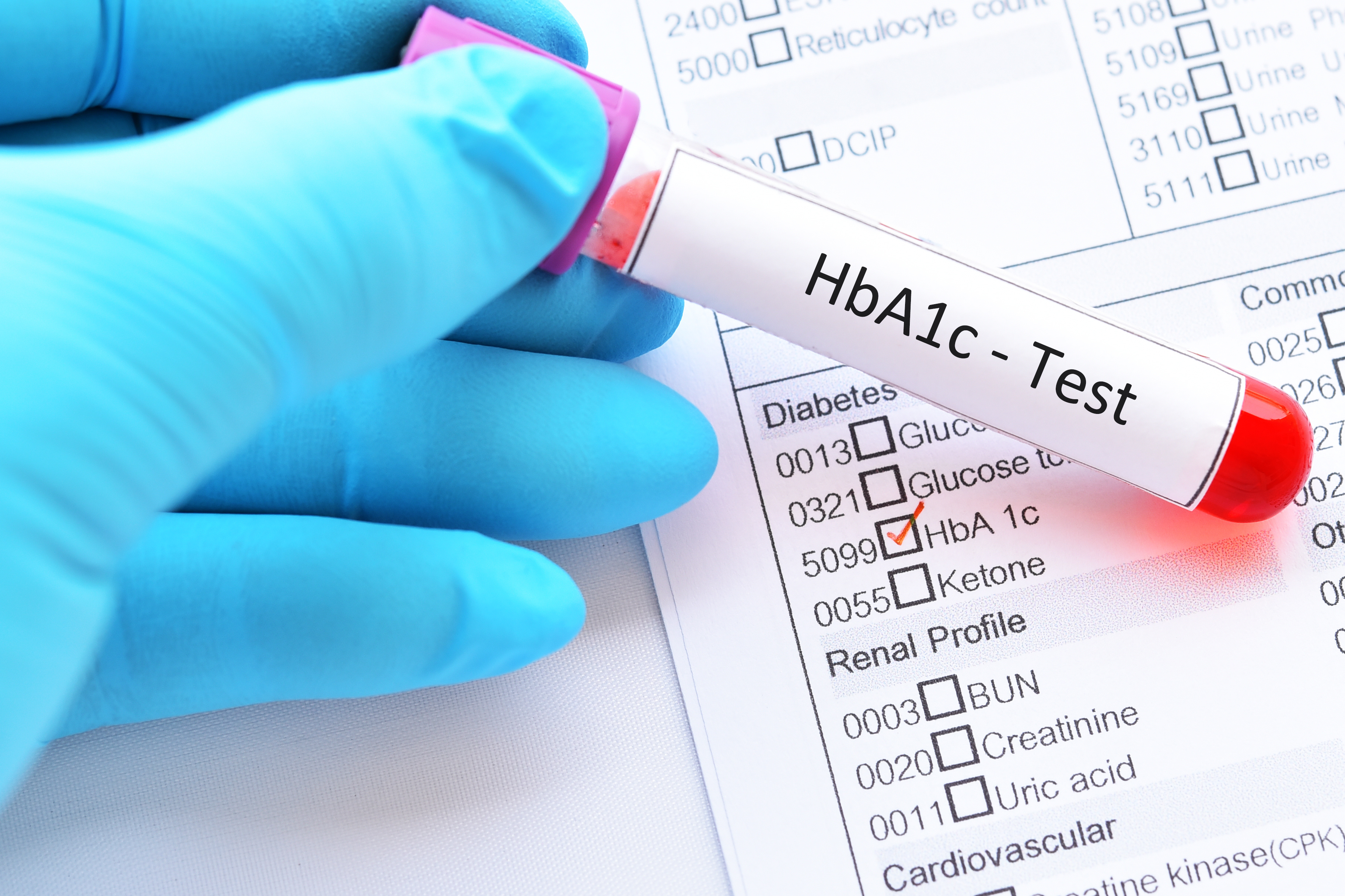 La durée de vie avec une hémoglobine glyquée (HbA1c) -une métrique standard de la glycémie- dans la plage recommandée est bien un facteur de réduction du risque de démence chez les personnes âgées diabétiques (Visuel Adobe Stock 211144940)