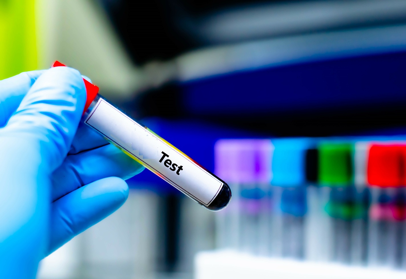 Disposer d&rsquo;un simple test sanguin en routine clinique pour pouvoir d&eacute;tecter voire &eacute;valuer le d&eacute;clin cognitif et son &eacute;volution possible (Visuel Adobe Stock 962977838)